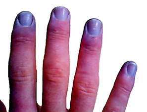 Cyanosis is the medical term for a bluish color of the skin
